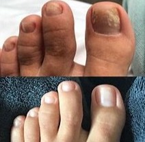 Kerassentials oils before after